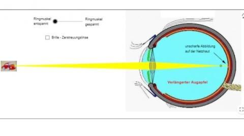 Interaktion: Kurzsichtigkeit des Auges
